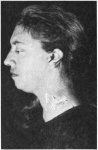 Microtia